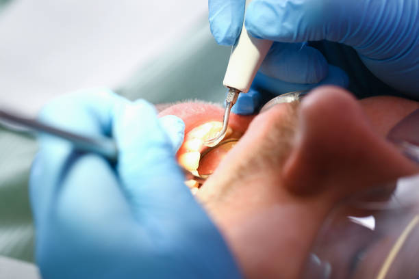 Teeth Whitening in VA